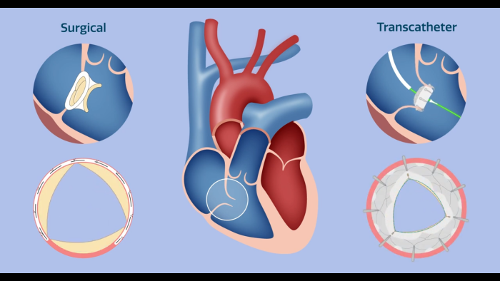 tricuspid