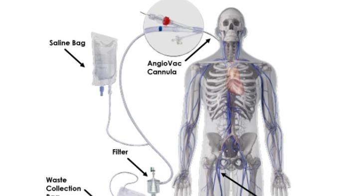 angiovac diagram