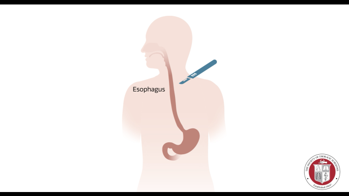 esophagectomy drawing