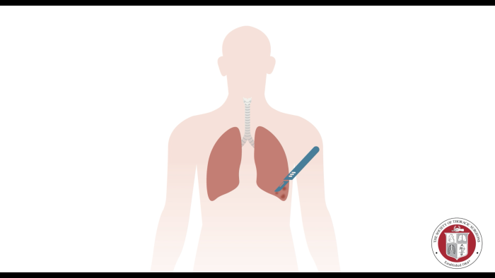 Lung Resection 