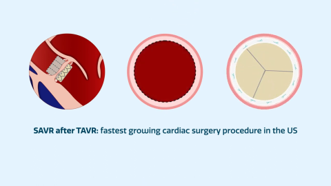 SAVR after TAVR