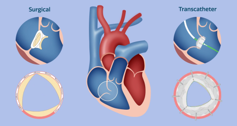 tricuspid