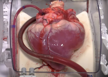cardiac transplant graphic 2