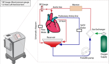 cardian transplant graphic